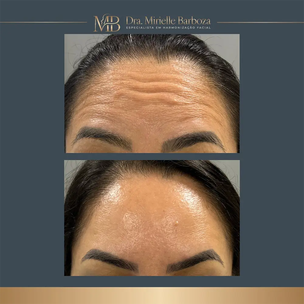 Antes e depois de tratamento estético facial, caso 01