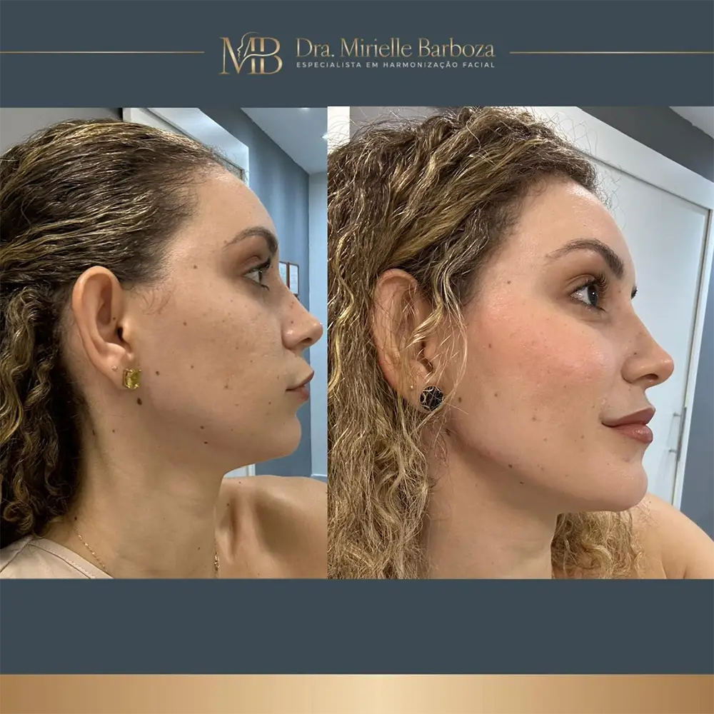 Antes e depois de tratamento estético facial, caso 10
