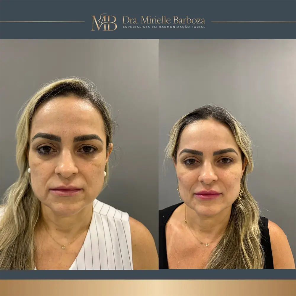 Antes e depois de tratamento estético facial, caso 02