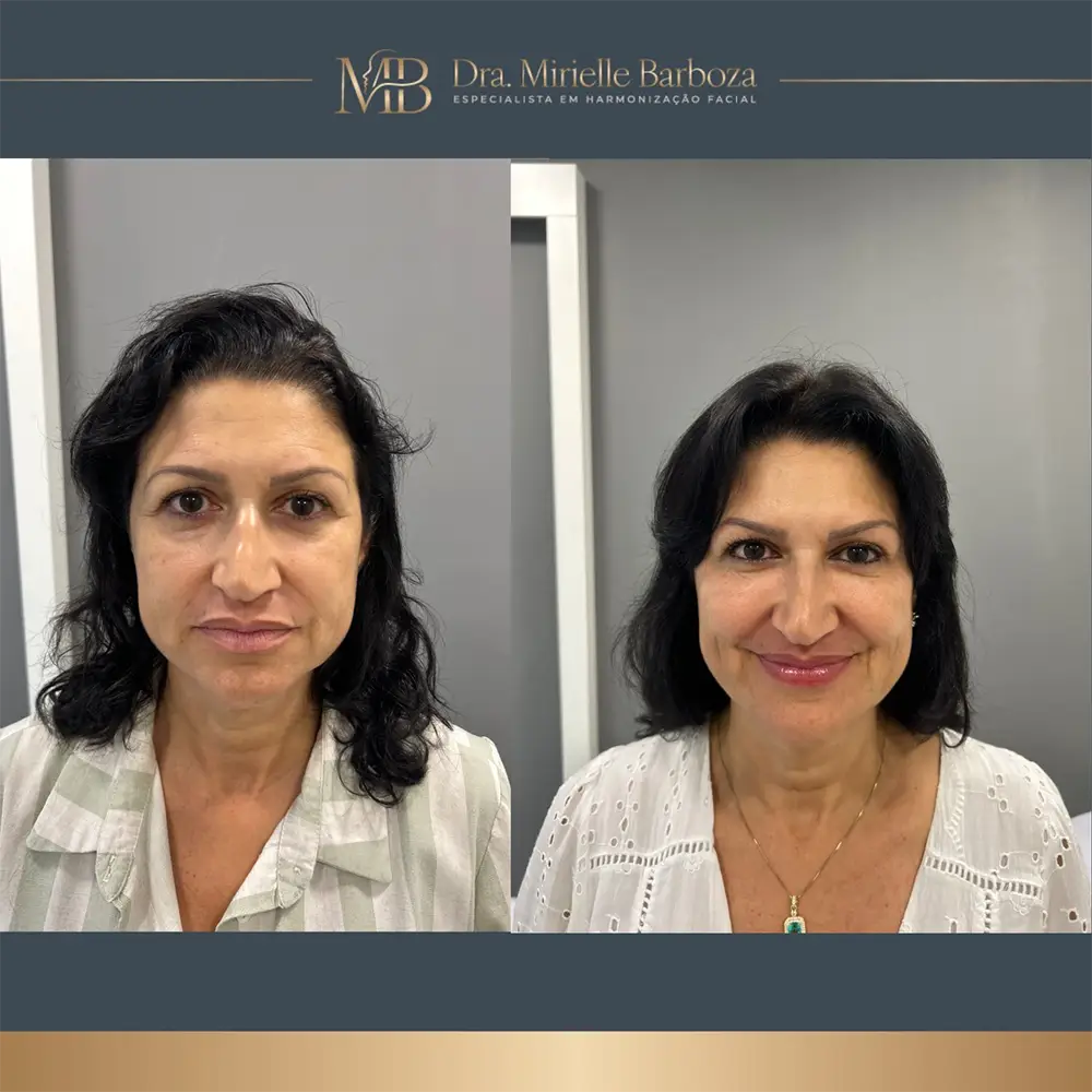 Antes e depois de tratamento estético facial, caso 03