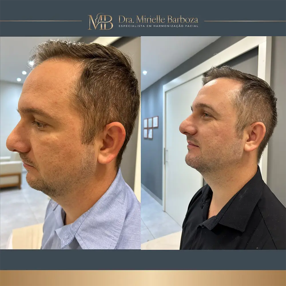 Antes e depois de tratamento estético facial, caso 04