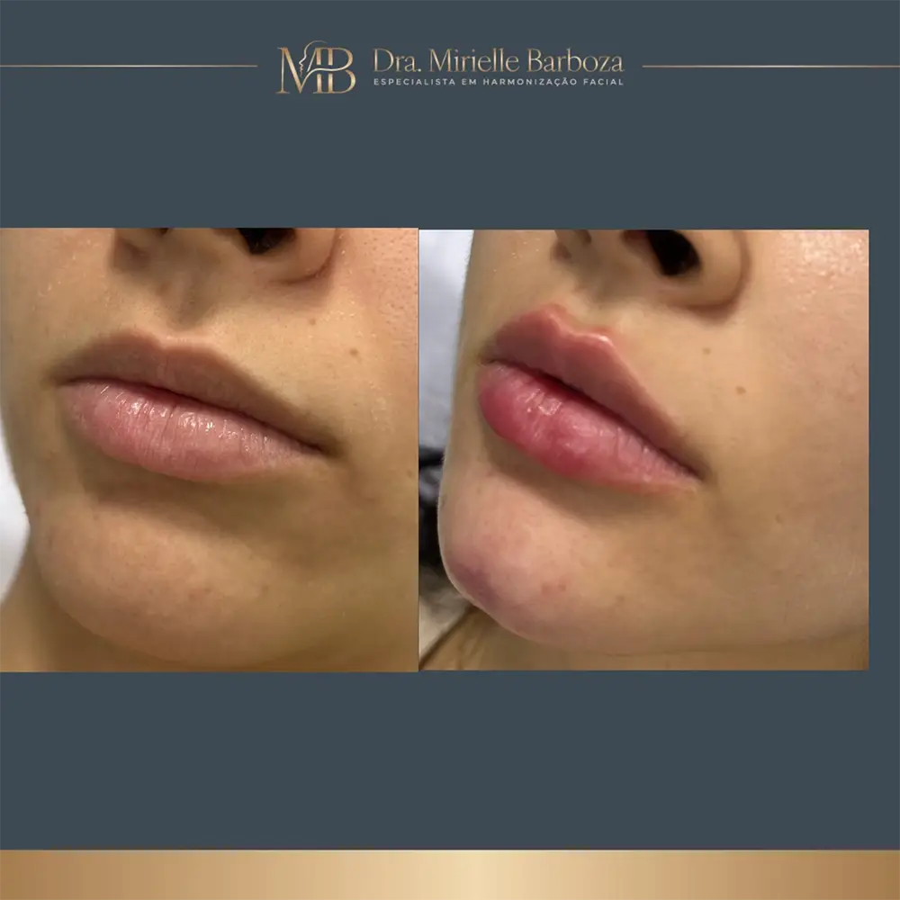 Antes e depois de tratamento estético facial, caso 05