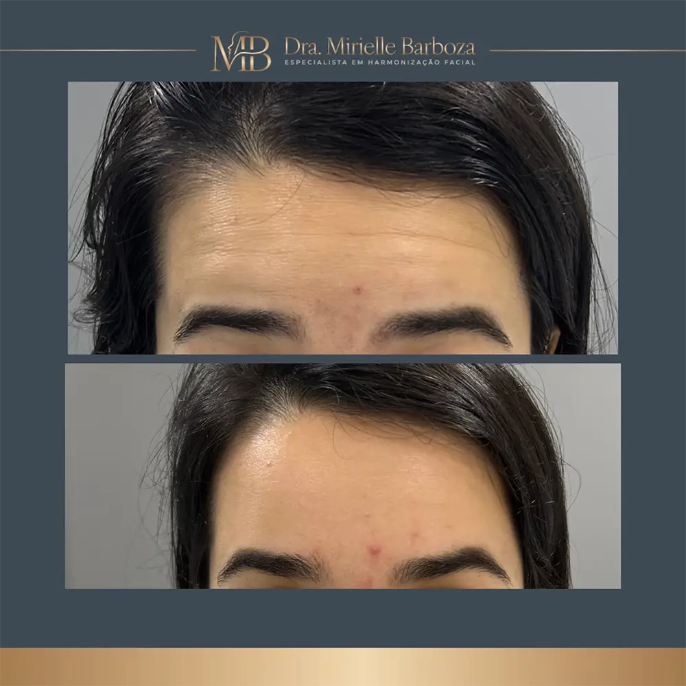 Antes e depois de tratamento estético facial, caso 06