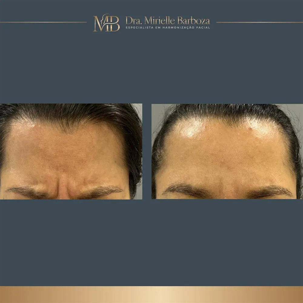 Antes e depois de tratamento estético facial, caso 07