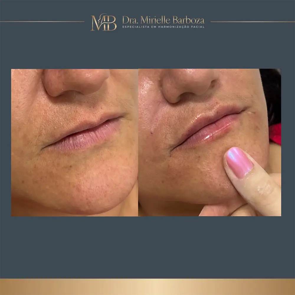 Antes e depois de tratamento estético facial, caso 08