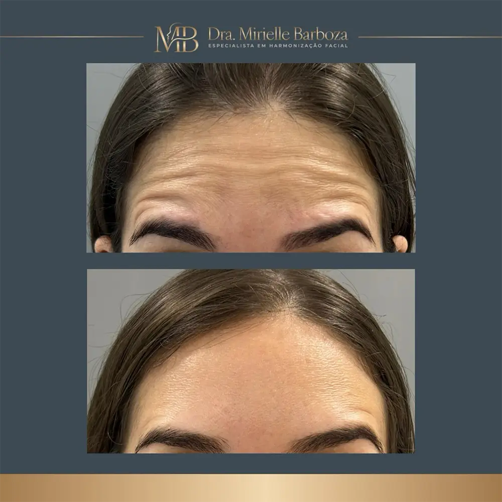 Antes e depois de tratamento estético facial, caso 09